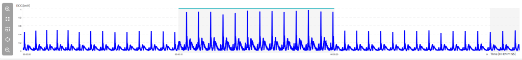 Graph showing ECG measurements over time, with blue lines indicating electrical activity in millivolts.
